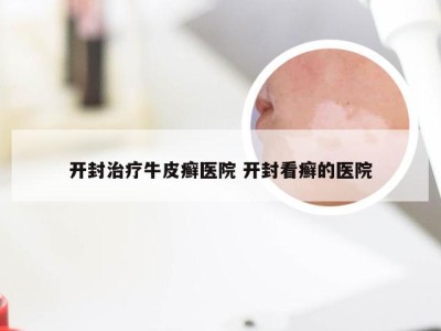 开封治疗牛皮癣医院 开封看癣的医院
