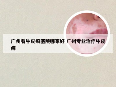 广州看牛皮癣医院哪家好 广州专业治疗牛皮癣
