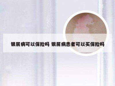 银屑病可以保险吗 银屑病患者可以买保险吗