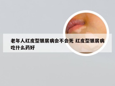 老年人红皮型银屑病会不会死 红皮型银屑病吃什么药好
