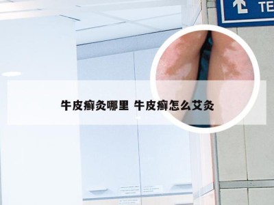 牛皮癣灸哪里 牛皮癣怎么艾灸
