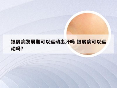 银屑病发展期可以运动出汗吗 银屑病可以运动吗?