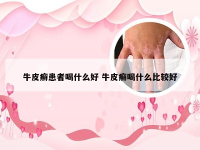 牛皮癣患者喝什么好 牛皮癣喝什么比较好