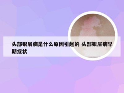 头部银屑病是什么原因引起的 头部银屑病早期症状