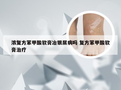 浓复方苯甲酸软膏冶银屑病吗 复方苯甲酸软膏治疗