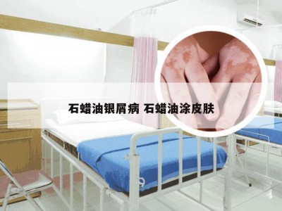 石蜡油银屑病 石蜡油涂皮肤