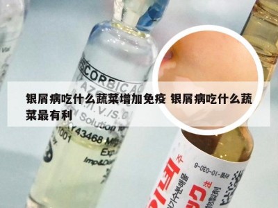 银屑病吃什么蔬菜增加免疫 银屑病吃什么蔬菜最有利