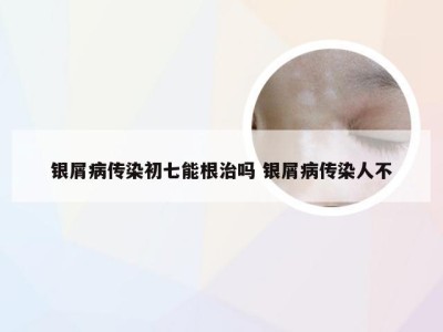 银屑病传染初七能根治吗 银屑病传染人不