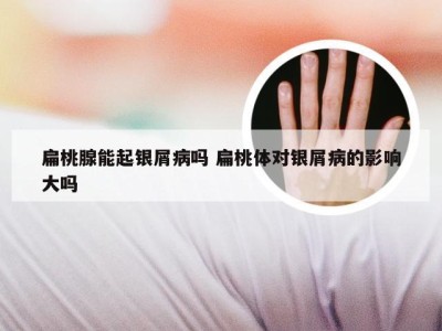 扁桃腺能起银屑病吗 扁桃体对银屑病的影响大吗