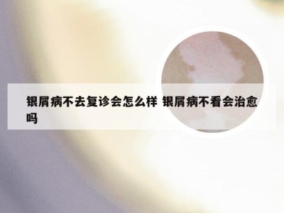 银屑病不去复诊会怎么样 银屑病不看会治愈吗