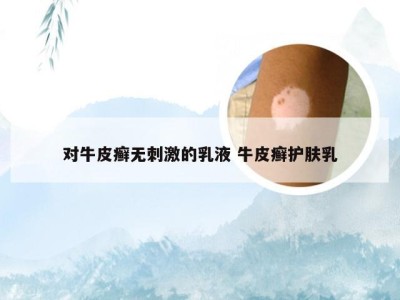 对牛皮癣无刺激的乳液 牛皮癣护肤乳