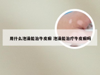 用什么泡澡能治牛皮癣 泡澡能治疗牛皮癣吗