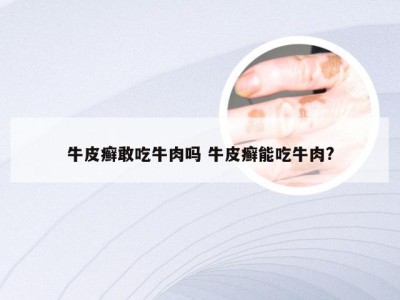 牛皮癣敢吃牛肉吗 牛皮癣能吃牛肉?
