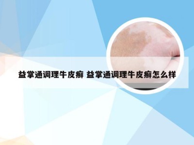 益掌通调理牛皮癣 益掌通调理牛皮癣怎么样