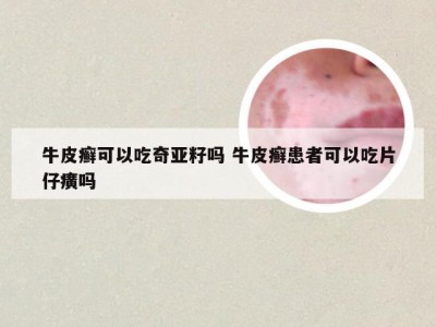 牛皮癣可以吃奇亚籽吗 牛皮癣患者可以吃片仔癀吗