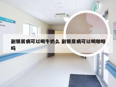 副银屑病可以喝牛奶么 副银屑病可以喝咖啡吗