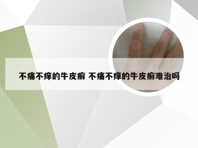 不痛不痒的牛皮癣 不痛不痒的牛皮癣难治吗