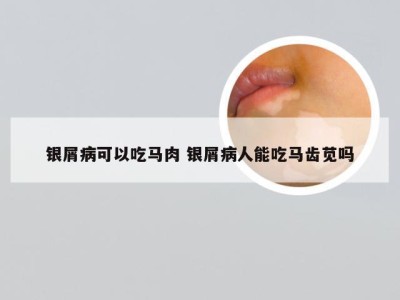 银屑病可以吃马肉 银屑病人能吃马齿苋吗