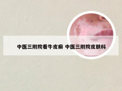 中医三附院看牛皮癣 中医三附院皮肤科