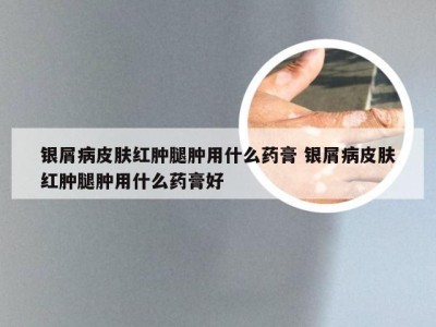 银屑病皮肤红肿腿肿用什么药膏 银屑病皮肤红肿腿肿用什么药膏好