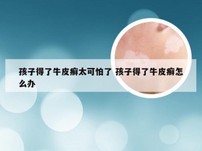 孩子得了牛皮癣太可怕了 孩子得了牛皮癣怎么办
