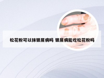 松花粉可以抹银屑病吗 银屑病能吃松花粉吗
