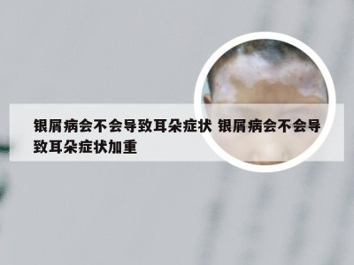 银屑病会不会导致耳朵症状 银屑病会不会导致耳朵症状加重