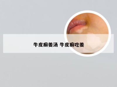 牛皮癣姜汤 牛皮癣吃姜