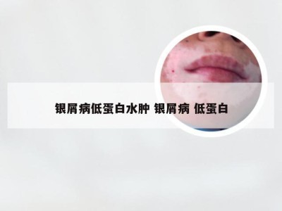 银屑病低蛋白水肿 银屑病 低蛋白