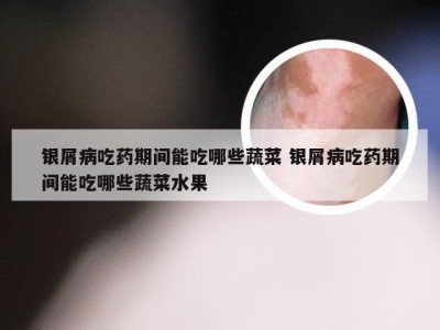 银屑病吃药期间能吃哪些蔬菜 银屑病吃药期间能吃哪些蔬菜水果