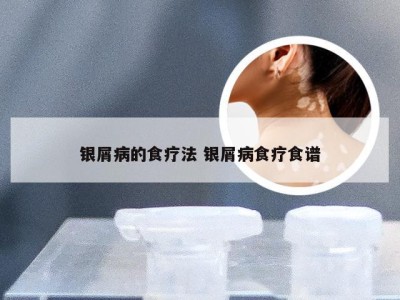 银屑病的食疗法 银屑病食疗食谱