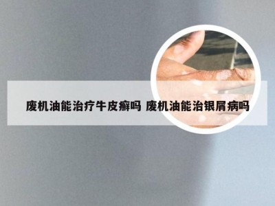 废机油能治疗牛皮癣吗 废机油能治银屑病吗