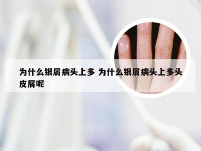 为什么银屑病头上多 为什么银屑病头上多头皮屑呢