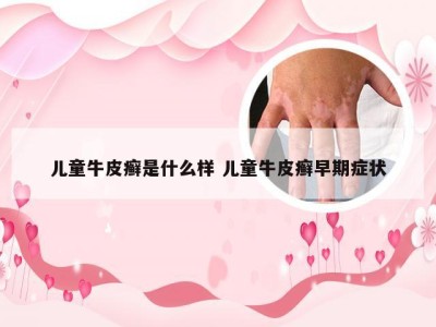 儿童牛皮癣是什么样 儿童牛皮癣早期症状