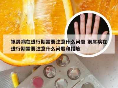 银屑病在进行期需要注意什么问题 银屑病在进行期需要注意什么问题和措施