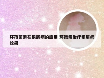 环孢菌素在银屑病的应用 环孢素治疗银屑病效果
