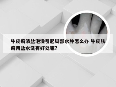 牛皮癣浓盐泡澡引起脚部水肿怎么办 牛皮肤癣用盐水洗有好处嘛?