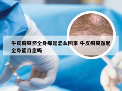 牛皮癣突然全身痒是怎么回事 牛皮癣突然起全身能自愈吗