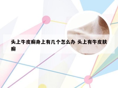 头上牛皮癣身上有几个怎么办 头上有牛皮肤癣