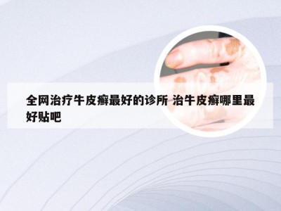 全网治疗牛皮癣最好的诊所 治牛皮癣哪里最好贴吧