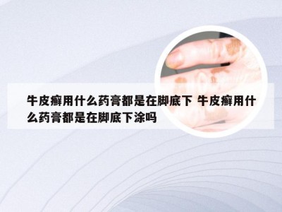 牛皮癣用什么药膏都是在脚底下 牛皮癣用什么药膏都是在脚底下涂吗