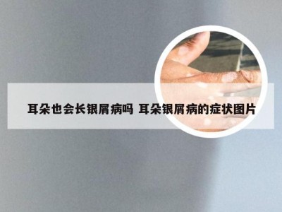 耳朵也会长银屑病吗 耳朵银屑病的症状图片