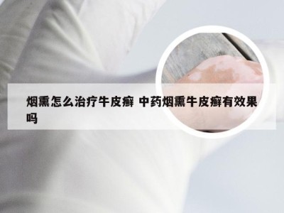 烟熏怎么治疗牛皮癣 中药烟熏牛皮癣有效果吗
