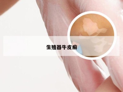 生殖器牛皮癣