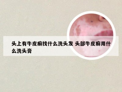 头上有牛皮癣找什么洗头发 头部牛皮癣用什么洗头膏