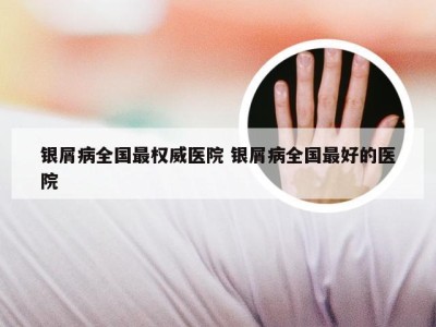 银屑病全国最权威医院 银屑病全国最好的医院