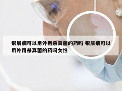 银屑病可以用外用杀真菌的药吗 银屑病可以用外用杀真菌的药吗女性