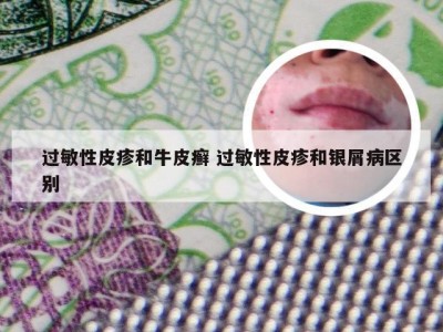 过敏性皮疹和牛皮癣 过敏性皮疹和银屑病区别