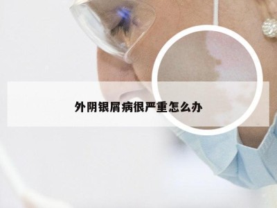 外阴银屑病很严重怎么办