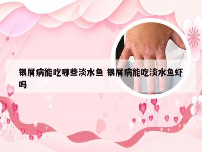 银屑病能吃哪些淡水鱼 银屑病能吃淡水鱼虾吗